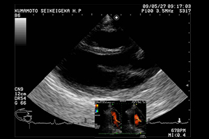 心臓超音波検査　左室長軸像