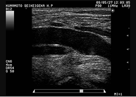 下肢静脈超音波検査　膝窩静脈
